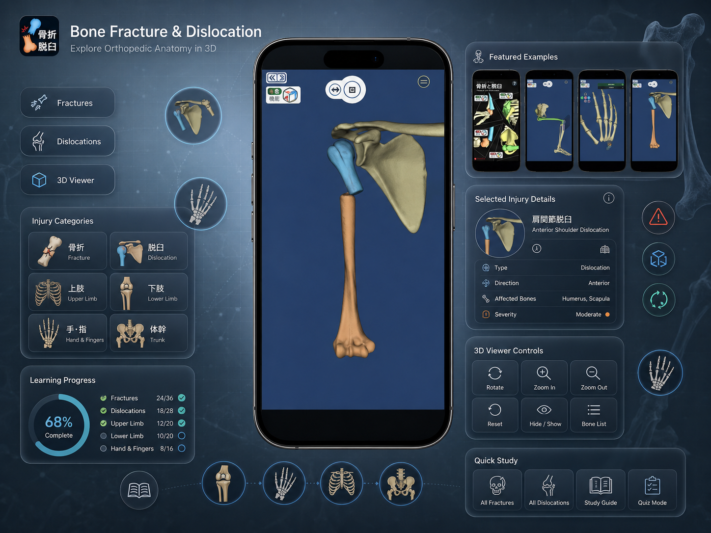 Bone Fractures